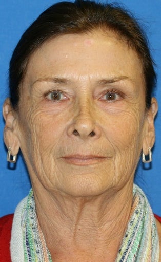 facelift