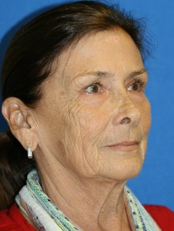 Facelift