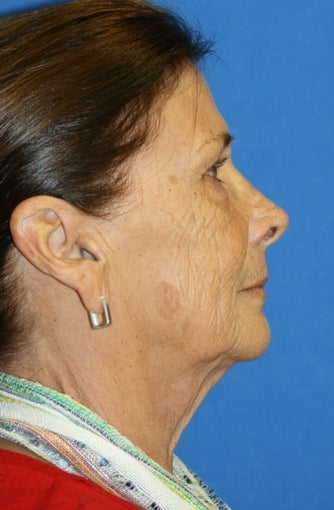 facelift