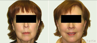 Facelift and Necklift