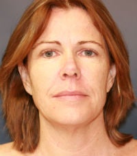 Facelift and laser resurfacing