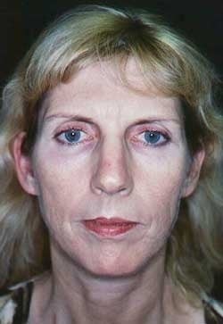 Mini-Cision Facelift