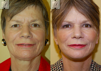 Facelift 