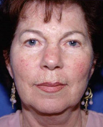 Facelift and Eyelid Surgery