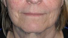 "Liquid facelift" with filler