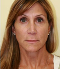 facelift