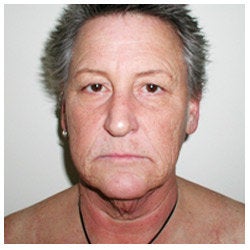 Upper and lower eyelid surgery, face lift, neck lift, and brow lift.