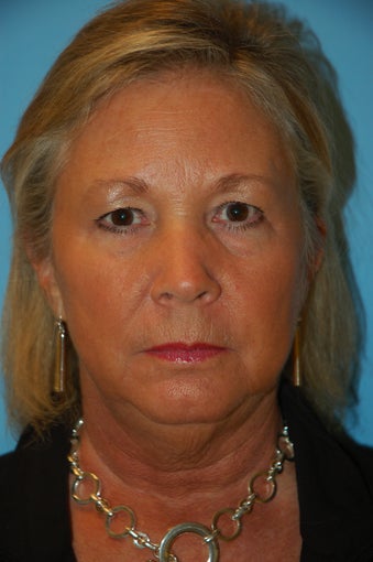 Facelift