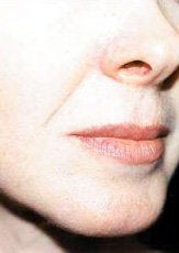 Facial Fillers
