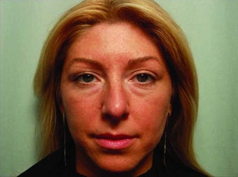 The Liquid Facelift