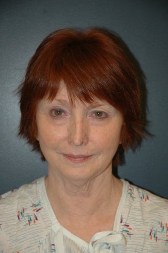Facelift