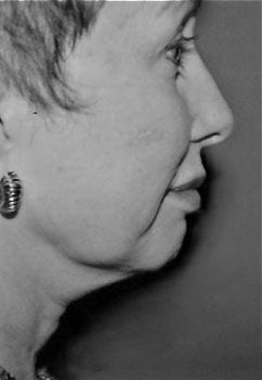 Facelift / Neck Lift