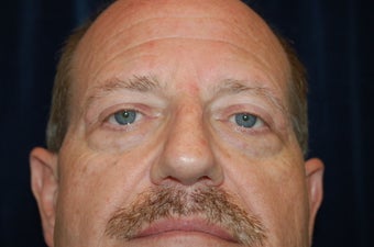 Face Lift and Lower Blepharoplasty