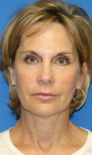 face Lift