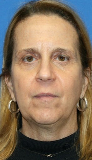 5 months post-op: Facelift, Necklift, Full Face Fat Transfer, and Lower Eyelid Skin Pinch