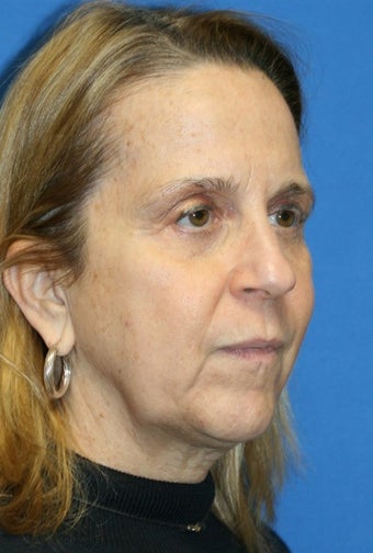 5 months post-op: Facelift, Necklift, Full Face Fat Transfer, and Lower Eyelid Skin Pinch