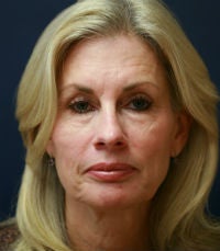 facelift