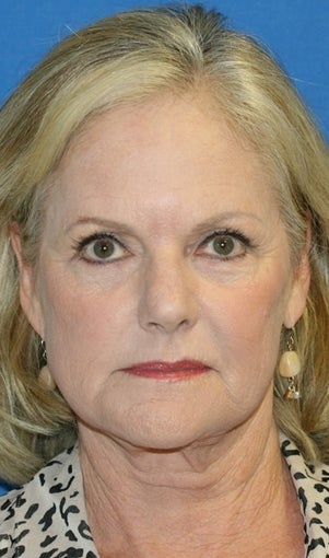 Short Incision Facelift and Lateral Browlift