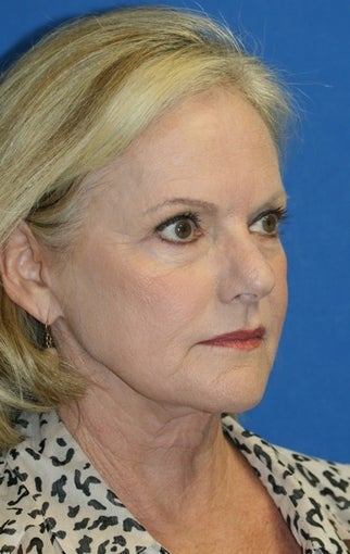 Short Incision Facelift and Lateral Browlift