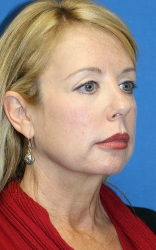 Facelift, Necklift, Fat Transfer, Upper Bleph., Lower Eyelid Skin Pinch