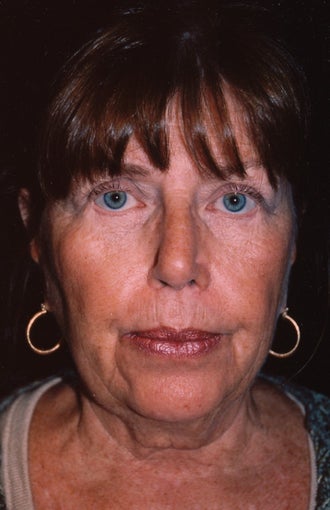 Facelift and blepharoplasty