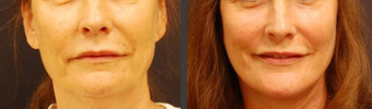 Facelift