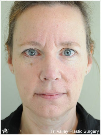 Facelift