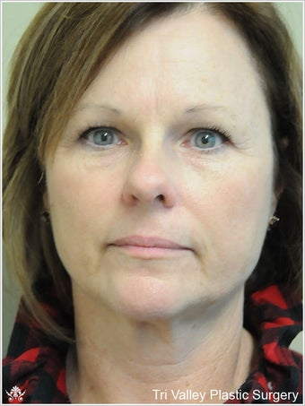 Facelift