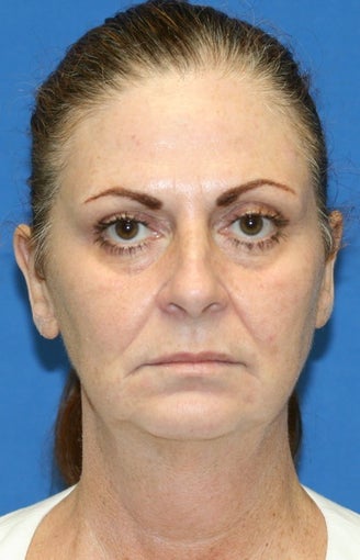 Facelift, Fat Transfer, Upper Bleph, Lower Eyelid Skin Pinch