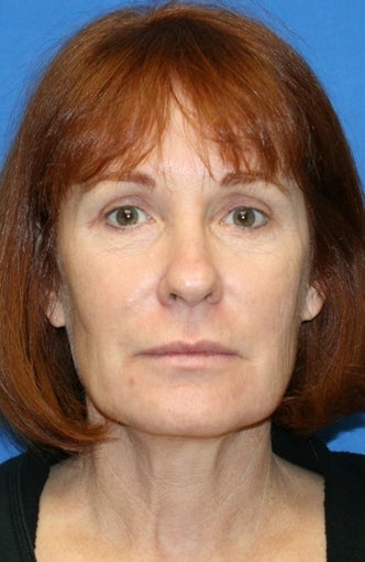 2 years post op: Facelift, Lower Eyelid Skin Pinch, and Peri-orbital Fat Transfer