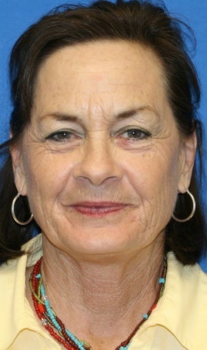 6 months post op: Facelift, Fat Transfer, Upper Bleph., Skin Pinch, & Chemical Peel