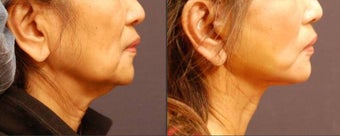 Facelift