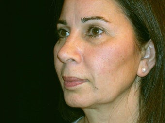 Complete Face Lift