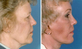 Facelift