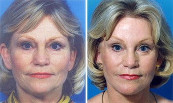 Facelift