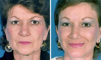 Facelift
