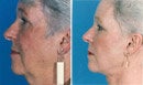 Facelift