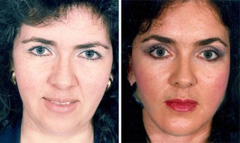 Facelift