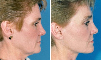 Facelift