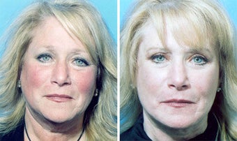 Facelift
