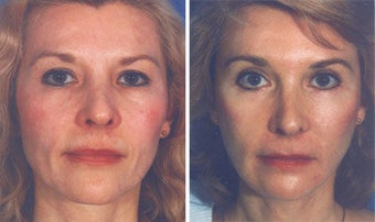 Facelift