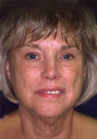 Facelift