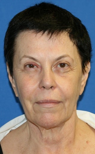Facelift with Extended Necklift, Browlift, Fat Transfer, Upper Blepharoplasty, and Skin Pinch