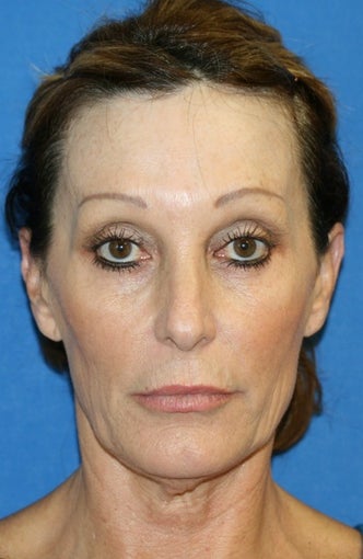 Facelift with Extended Necklift and Upper Blepharoplasty