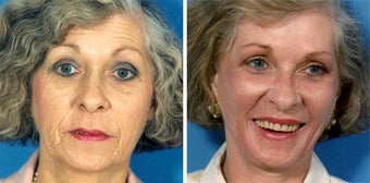 Facelift