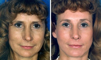 Facelift