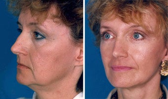 Facelift