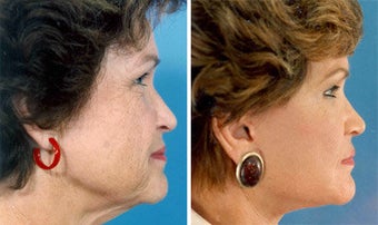 Facelift