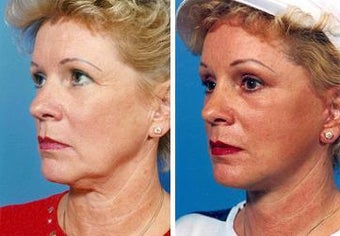 Facelift