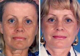 Facelift
